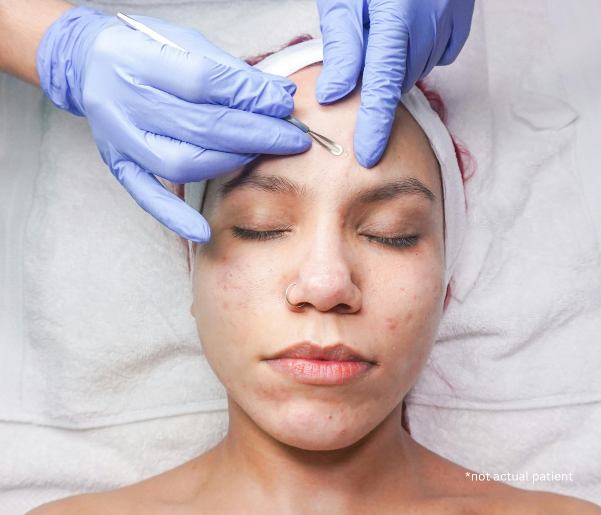 Understanding the Different Types of Acne