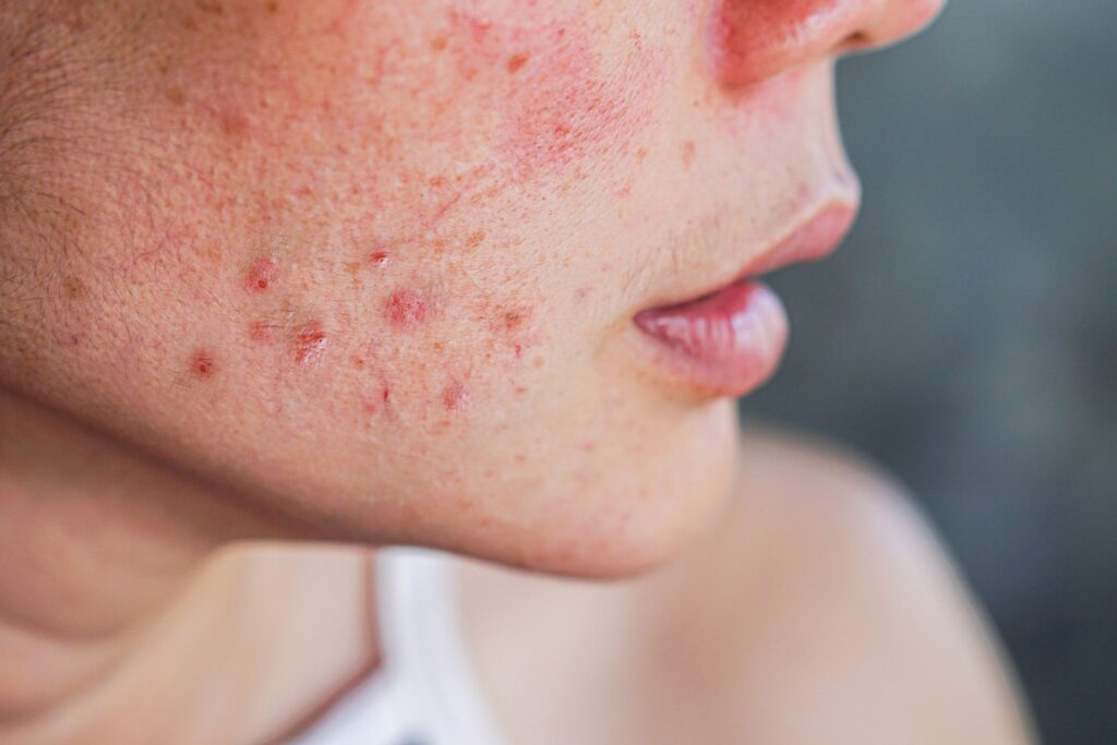 acne doctor fairfax va