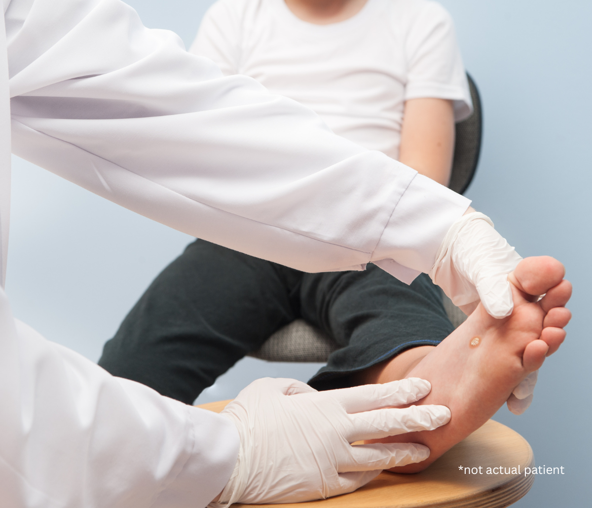Say Goodbye to Warts with Wart Removal in Fairfax, VA