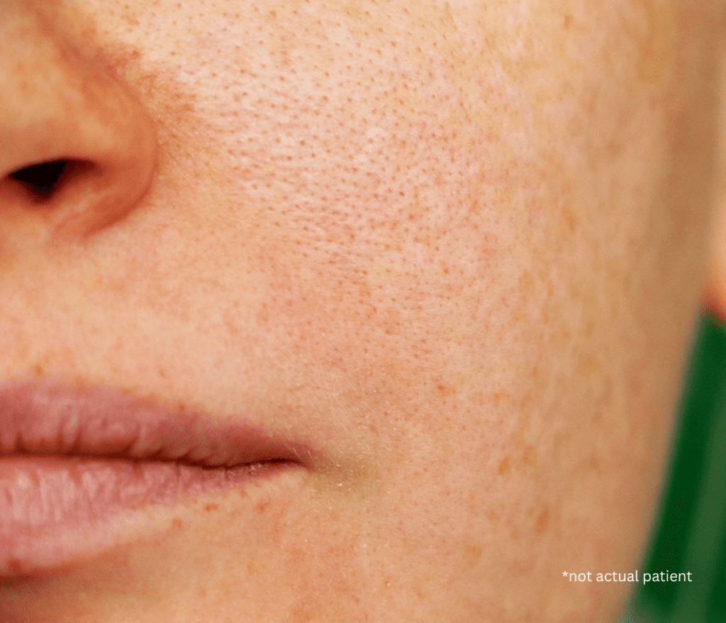 Melasma Treatment in Fairfax, VA