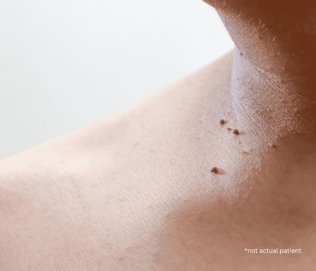 Skin Tag Removal in Fairfax, VA