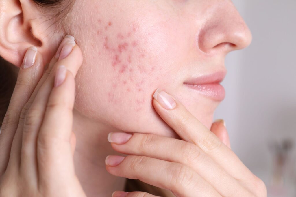 acne treatment in fairfax va