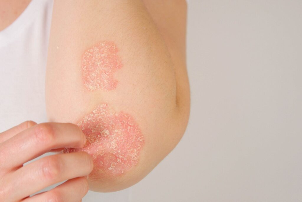 psoriasis treatment fairfax va