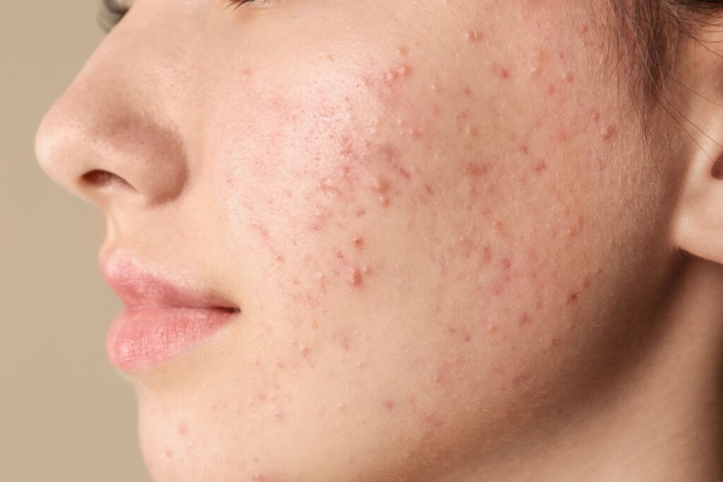 acne treatment in arlington va