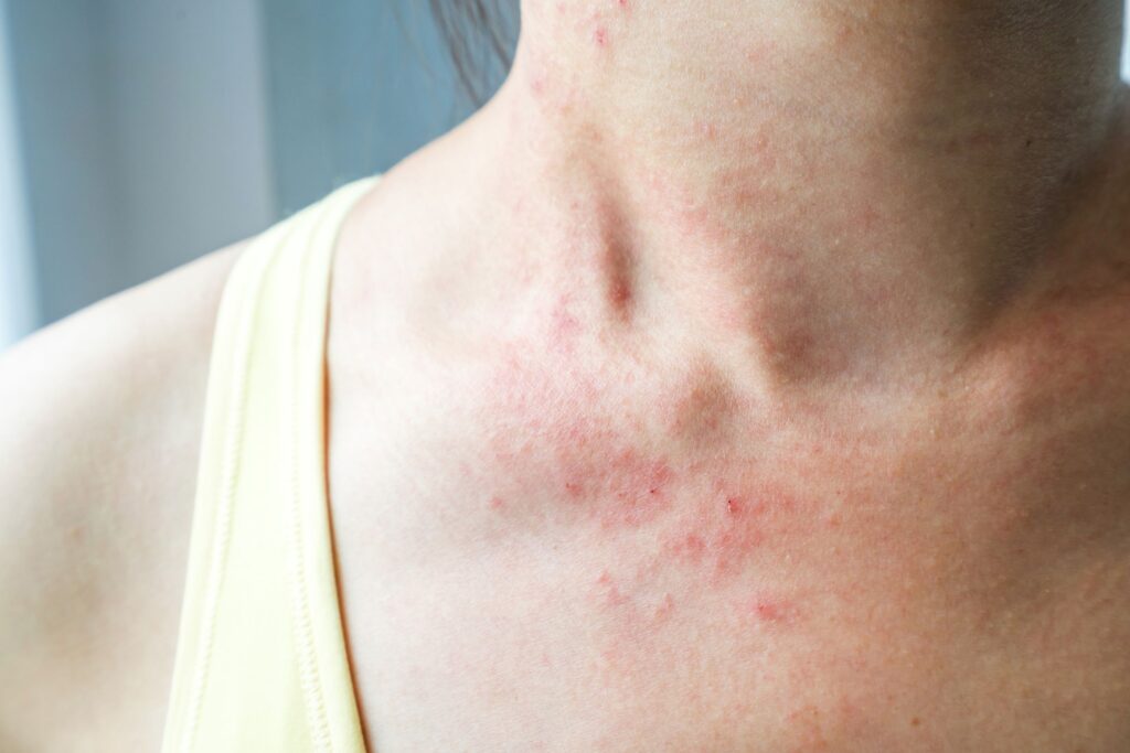 eczema treatment fairfax va