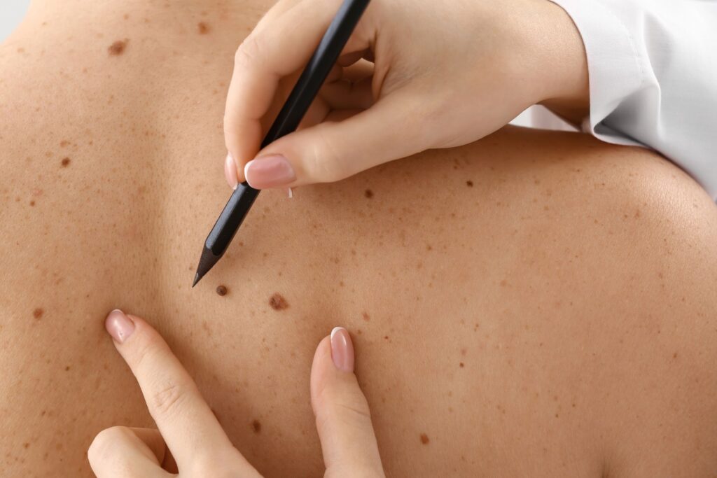 skin cancer treatment falls church