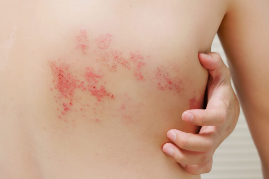 shingles rash treatment in fairfax va