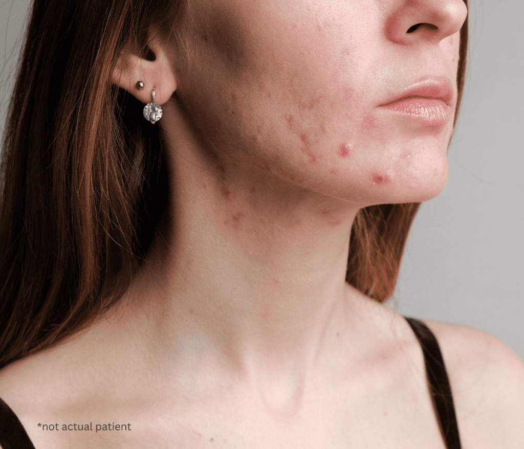 What an Acne Doctor in Fairfax, VA Wants You to Know About Adult Acne