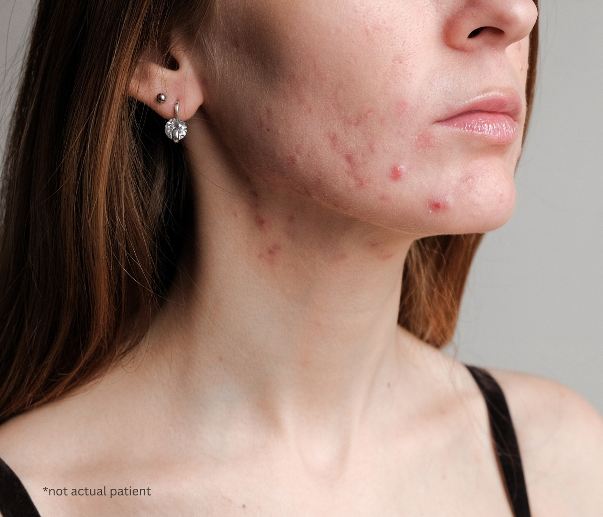 What an Acne Doctor in Fairfax, VA Wants You to Know About Adult Acne