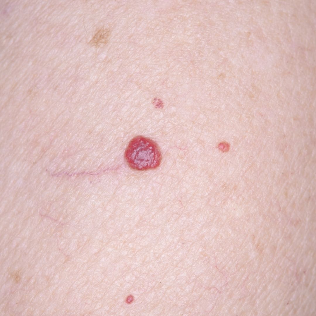cherry angioma removal fairfax