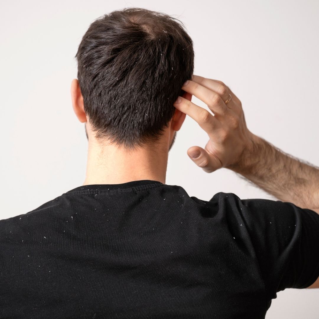 scalp doctor in fairfax man scratching head