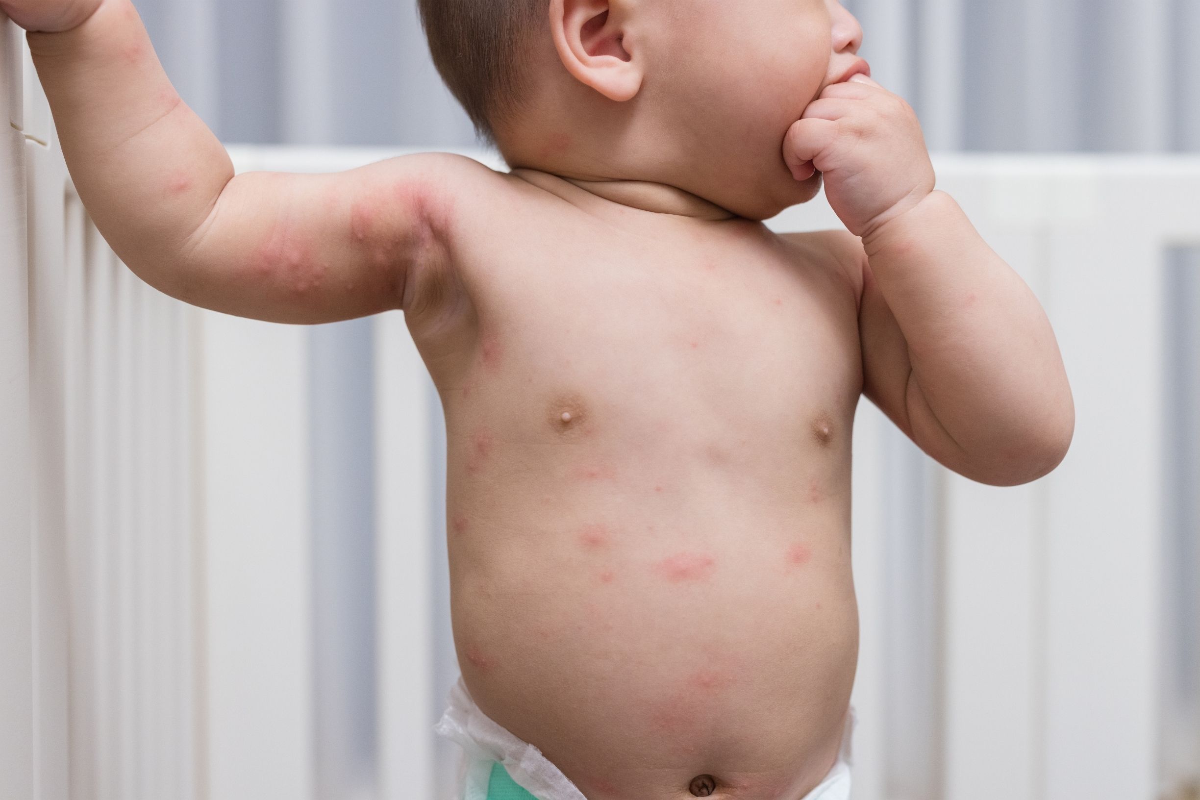 pediatric dermatologist near fairfax va