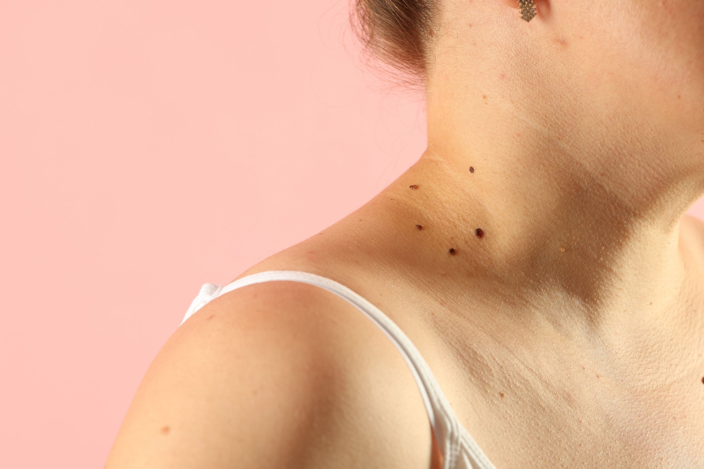 skin tag removal near fairfax va