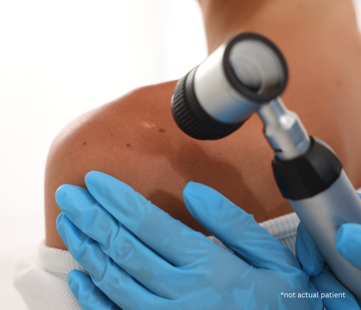 Skin Cancer Screening with a Dermatologist Near Fairfax, VA