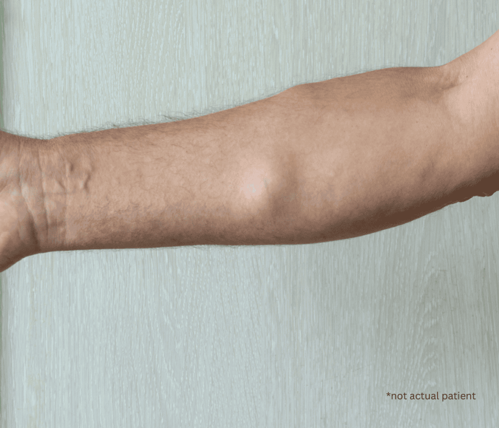 forearm of a person with a lump under the skin