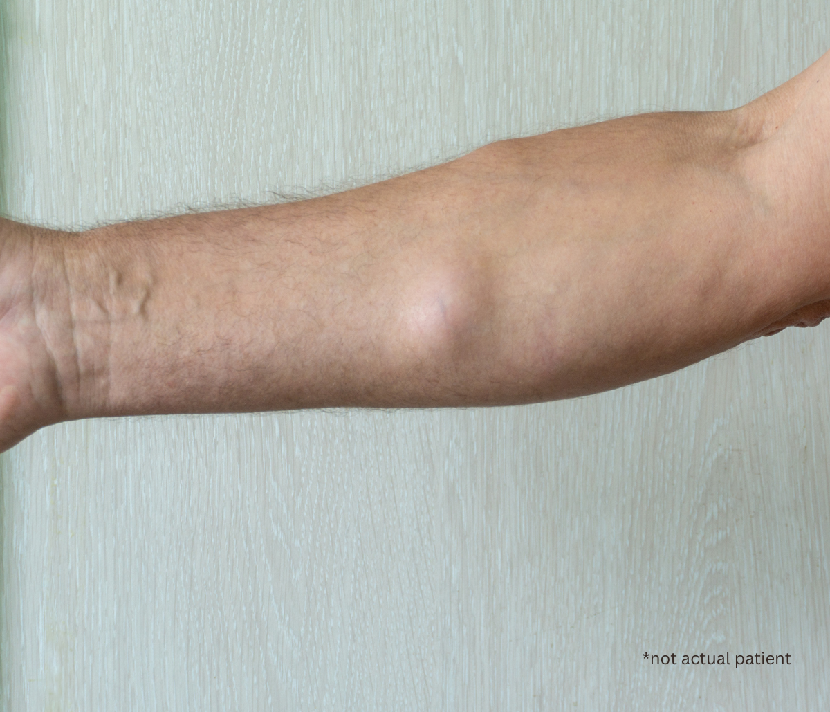 forearm of a person with a lump under the skin