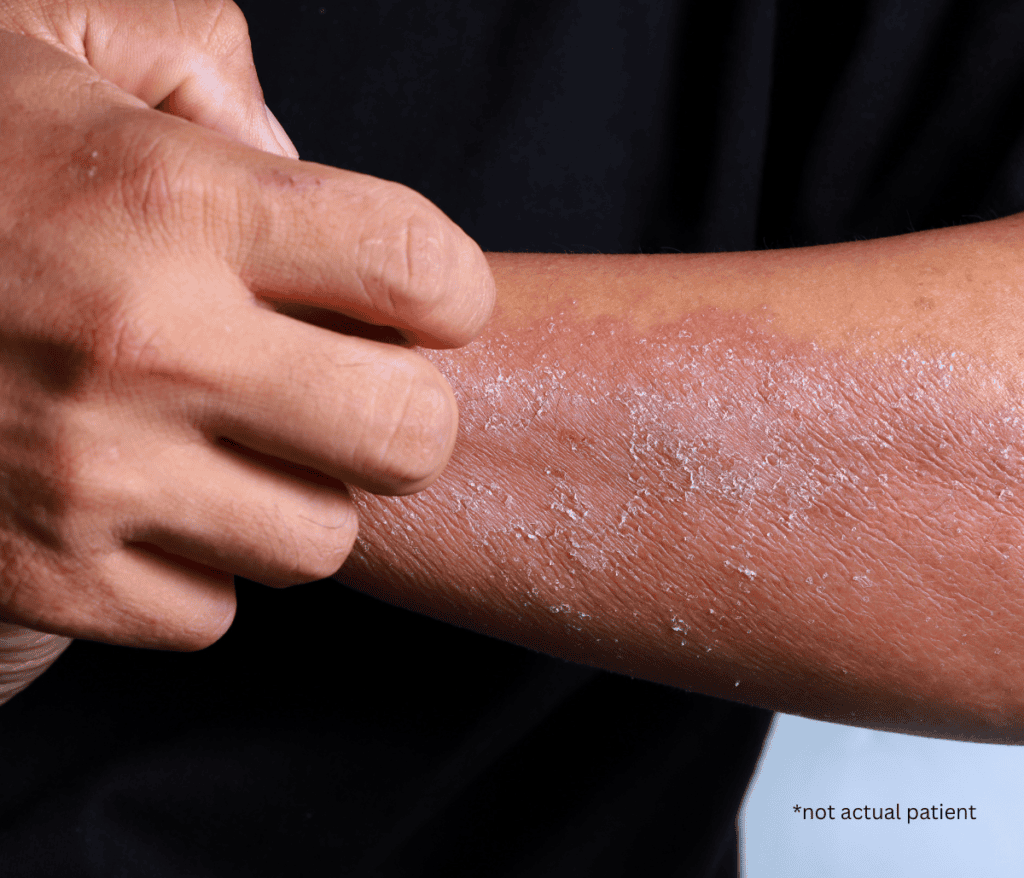 Is It Eczema or Psoriasis A Guide to Eczema Treatment in Fairfax, VA